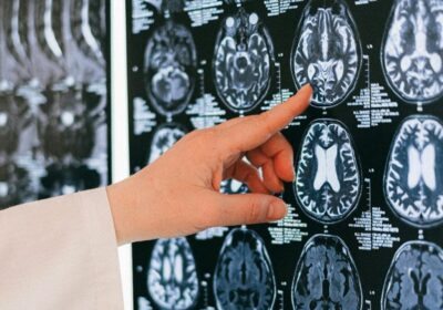 Epilepsiechirurgie stock 2025 01 07 111721 vfvh